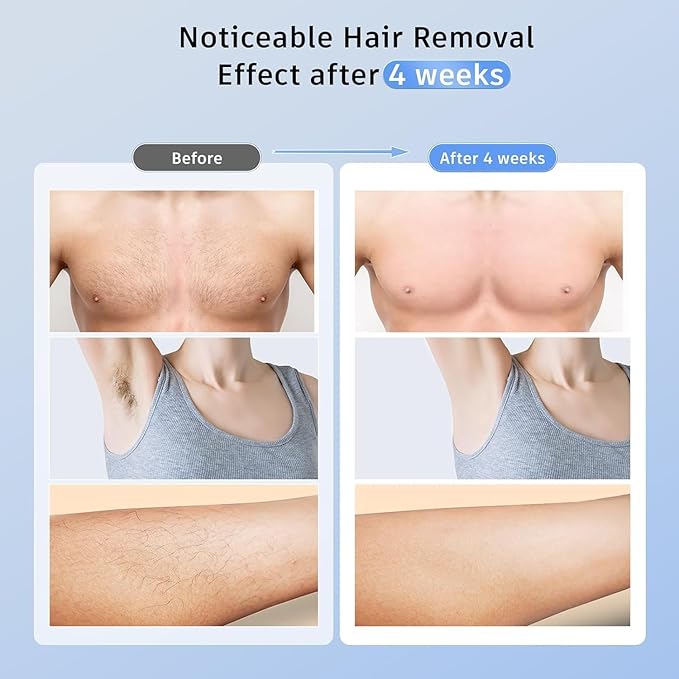 Laser Hair Removal Ubroo IPL Hair Removal Device with 5℃ Ice Cooling,Painless Laser Hair Removal for Women and Men,Full Body Use for Legs,Bikini,Armpits (Blue)