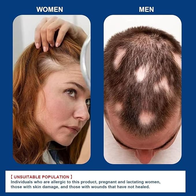 Kormesic 5% ミノキシジル 育毛スカルプマッサージクリーム、プロ仕様ヘアケア ミノキシジル、男女兼用 抜け毛防止トリートメント、ローズマリー ビオチン配合、素早い再成長 & 髪の根を強化 (2個セット)