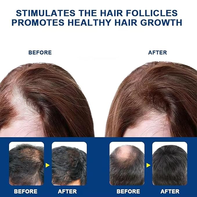 Kormesic 5% ミノキシジル 育毛スカルプマッサージクリーム、プロ仕様ヘアケア ミノキシジル、男女兼用 抜け毛防止トリートメント、ローズマリー ビオチン配合、素早い再成長 & 髪の根を強化 (2個セット)