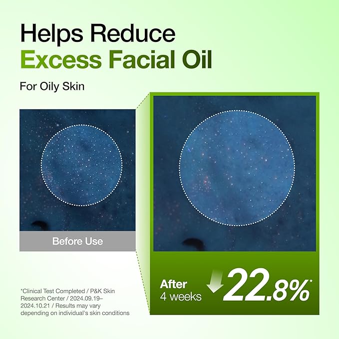 Anua Azelaic Acid 10 Hyaluron Redness Soothing Serum, Facial Serum for Blemish-Prone & Oily-Prone Skin, Lightweight & Hydrating Blemish Care, Hyaluronic Acid, Korean Skincare, 1.01 fl oz.