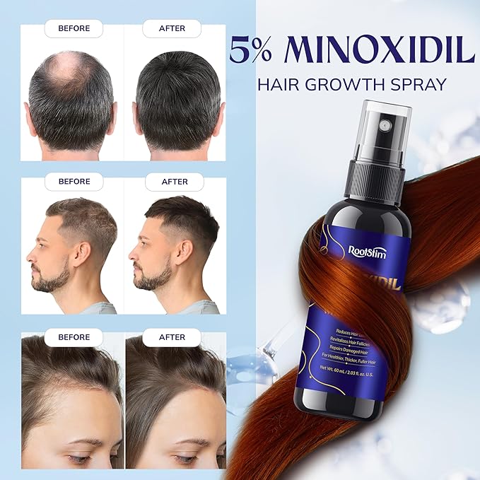 5% Minoxidil Kit for Men and Women – 6-Pack Beard Growth Kit & Hair Regrowth Spray – Targets Thinning Hairlines, Crowns & Patchy Beards – 360 mL