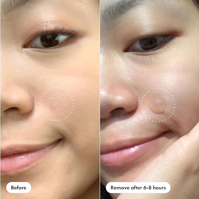 Mighty Patch Original Patch from Hero Cosmetics - #1 Hydrocolloid Acne Pimple Patches for Face, Shrinking Zits & Whiteheads in 1 Use, Nighttime Spot Pimple Stickers for Face, 75 Count