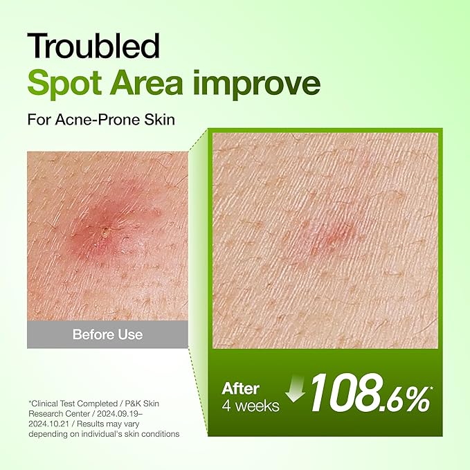 Anua Azelaic Acid 10 Hyaluron Redness Soothing Serum, Facial Serum for Blemish-Prone & Oily-Prone Skin, Lightweight & Hydrating Blemish Care, Hyaluronic Acid, Korean Skincare, 1.01 fl oz.