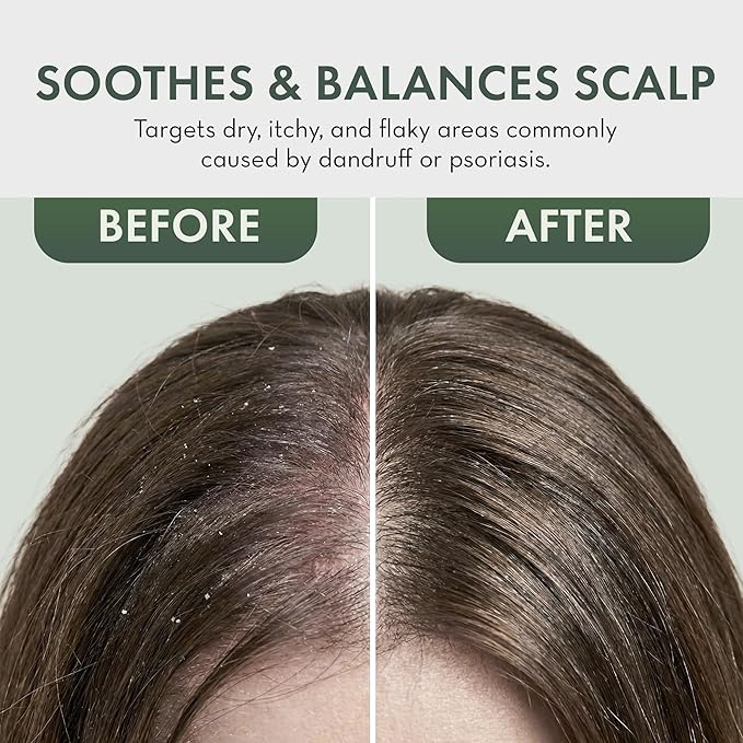 Leave In Conditioner Spray - Tea Tree Scalp Treatment - Anti-Dandruff and Dry & Itchy Scalp Treatment, Hydrating & Medicated Formula for Psoriasis and Scalp Care - Detangles & Nourishes Hair.